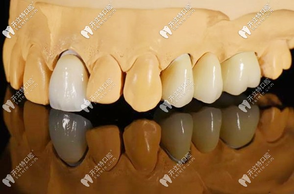 牙模上的全瓷牙冠展示图