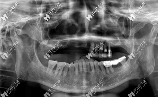 西安美奥牙科all-on-6种植牙案例