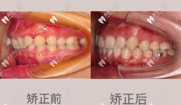 矫正案例 矫正案例