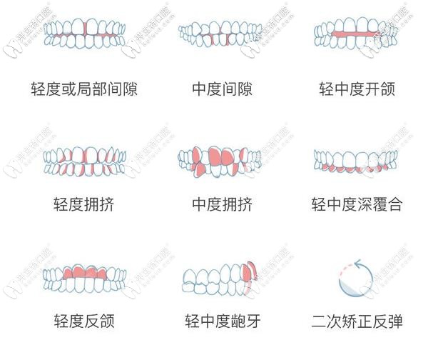瑞速齐隐形牙套——适应症范围 瑞速齐隐形牙套——适应症范围
