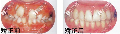 南昌辉煌口腔矫正案例 南昌辉煌口腔矫正案例