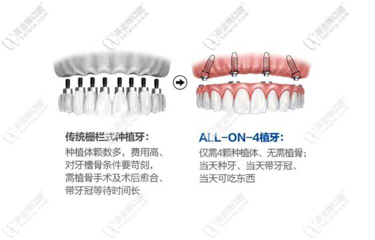 all-on-4种植牙技术