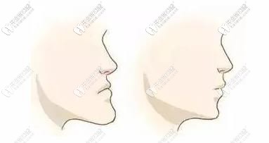 凸嘴：不及时矫正，影响面部轮廓生长