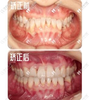 骨性反颌戴牙套效果 骨性反颌戴牙套效果