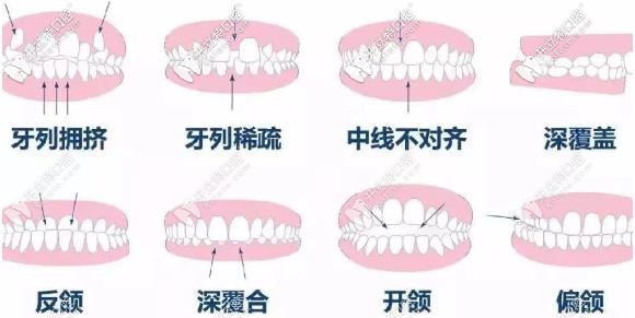 合肥美奥口腔牙齿矫正适应症