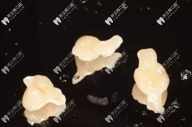 很少有人做马里兰桥义齿修复技术 很少有人做马里兰桥义齿修复技术