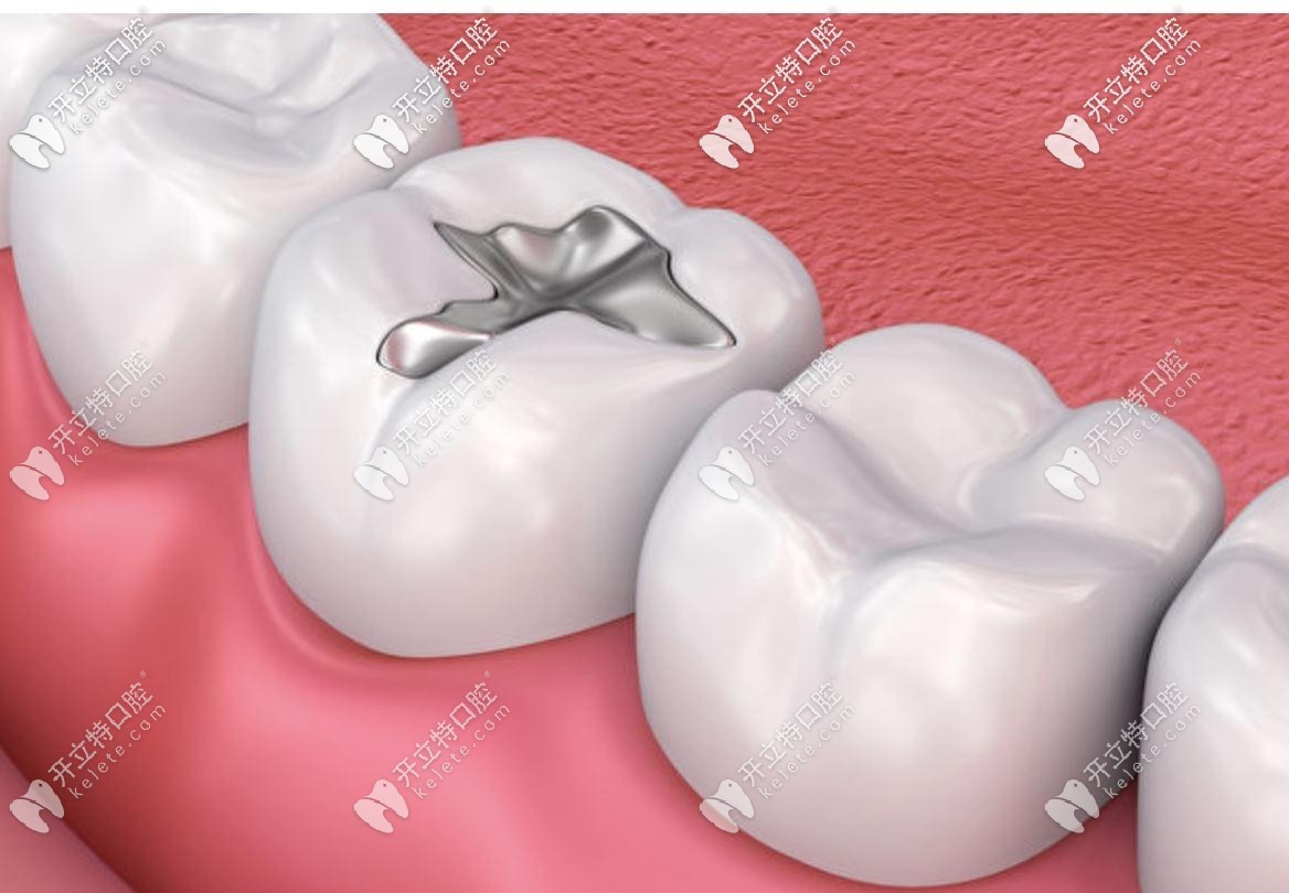 补牙的材料掉了跟医生的技术关系大吗，究其原因…