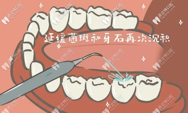 中级洁牙术的作用示意图
