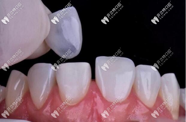 贵州人的牙齿为什么有黄斑这种氟斑牙通过治疗能去掉吗