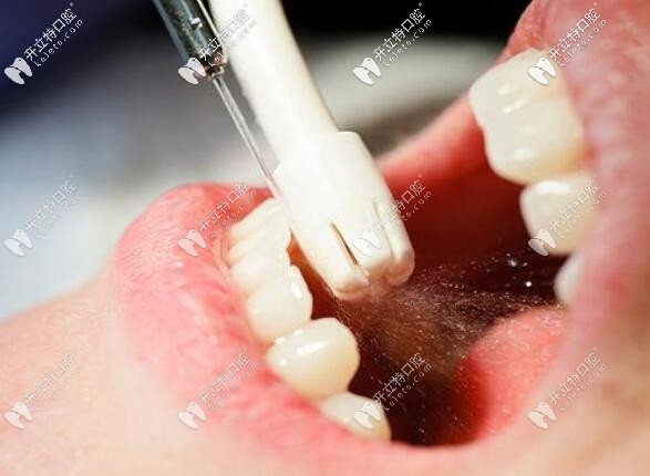 贵州人的牙齿为什么有黄斑这种氟斑牙通过治疗能去掉吗