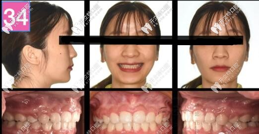 骨性二类龅牙单纯正畸侧貌效果图