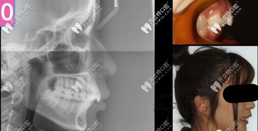 骨性二类凸嘴拔牙内收案例