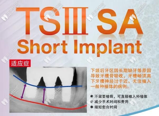 分享:韩国奥齿泰TSIII SA超短种植体优势及种植下颌牙的案例