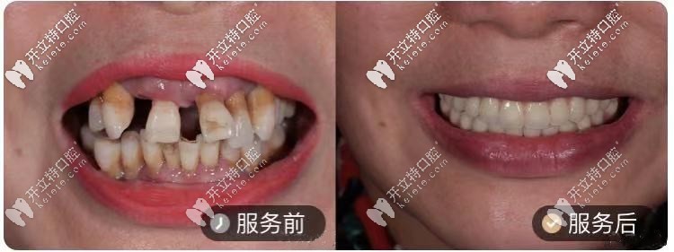 50岁阿姨，做的ALL-ON-4种植牙对比图