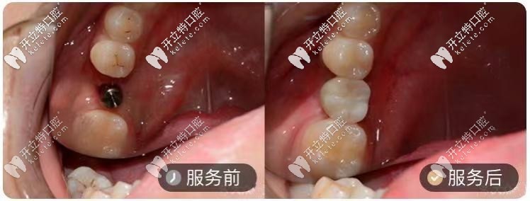 在长沙牙祖口腔做的1颗韩系种植牙对比图