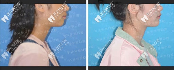 长沙牙祖口腔沙米矫正案例一