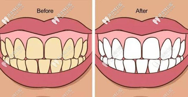 洗牙前后对比图