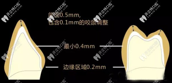 德国进口材料的格莱美全瓷牙价格 德国进口材料的格莱美全瓷牙价格