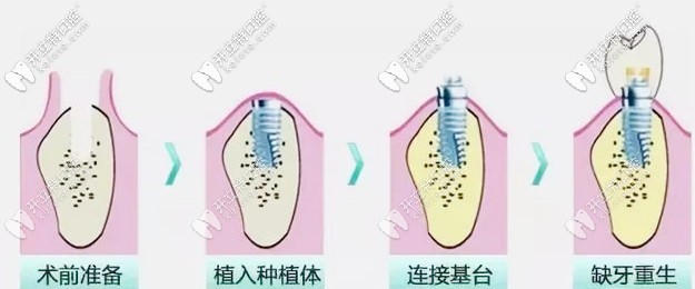 种植牙流程