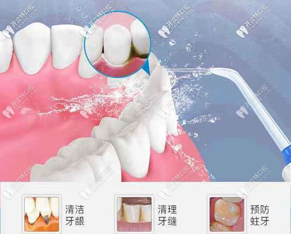 洗牙的作用