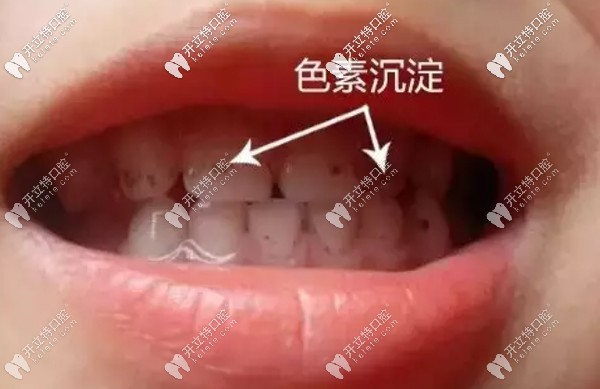 儿童因饮食牙齿容易色素沉淀