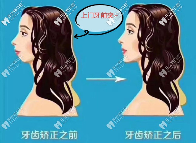 上门牙前突牙齿矫正多少钱?正畸方法不同价格也是有差别的