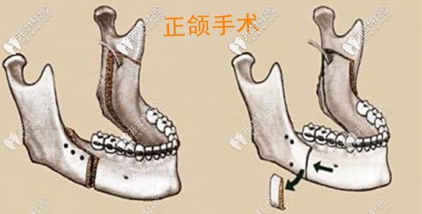 正颌手术