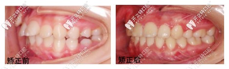 孙丹阳医生的矫正<span style=