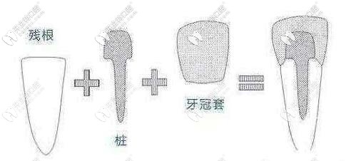 牙齿打桩的过程示意图