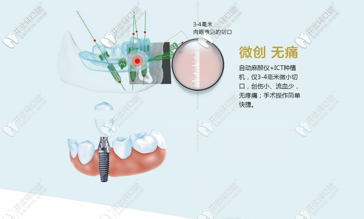 剖析微创种植牙技术,看不翻瓣种植牙手术视频过程及价格