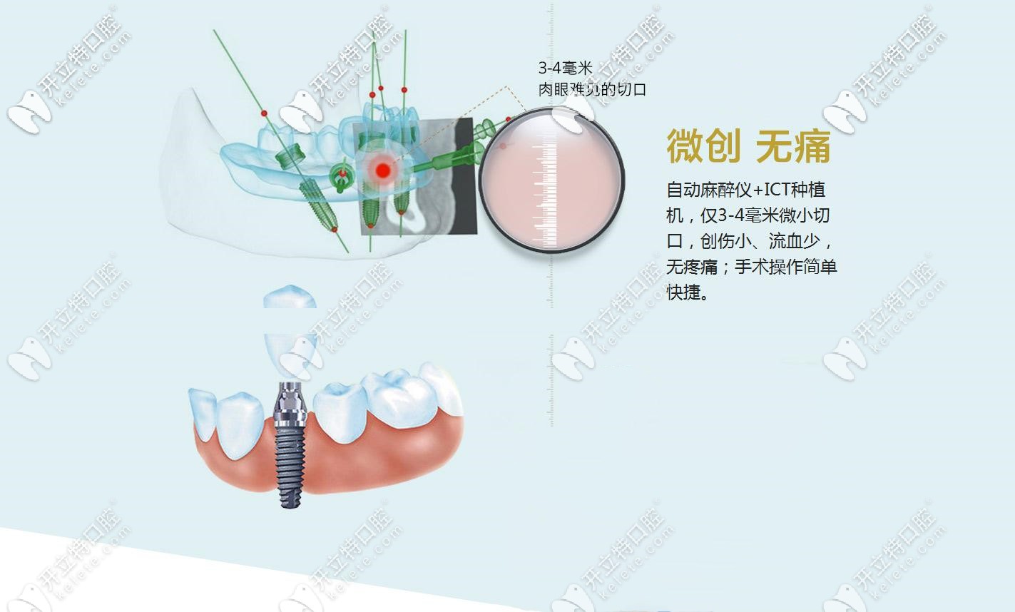 微创种植牙介绍