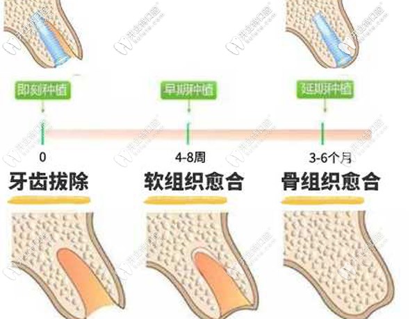 即拔即种种植技术