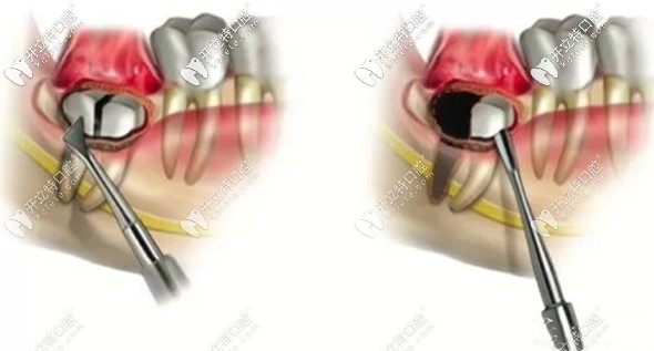 超声骨刀拔牙的过程示意图