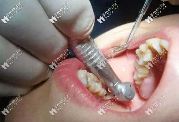 意向性牙再植术的专业介绍