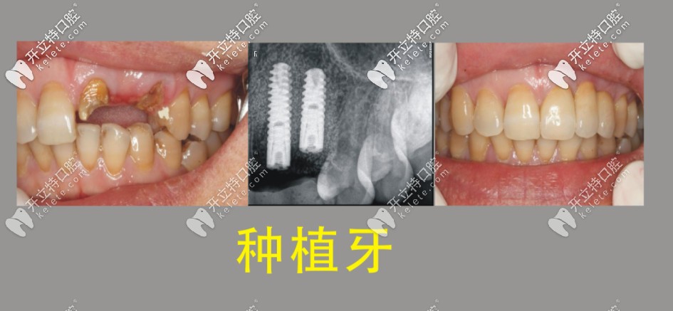 种植牙前后对比