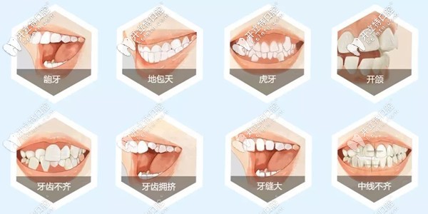牙齿矫正的类型 牙齿矫正的类型