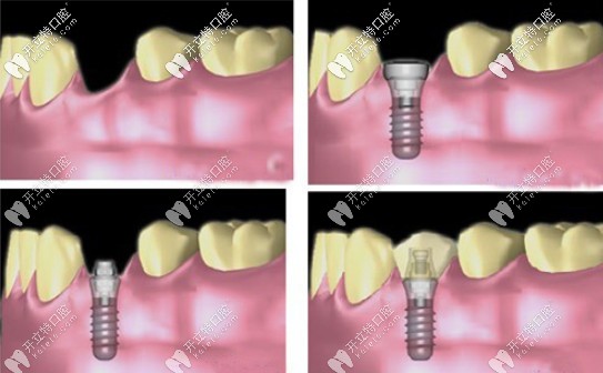 种植牙过程