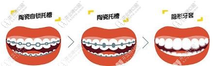 牙齿矫正牙套种类 牙齿矫正牙套种类