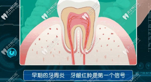 早期牙周炎，牙龈红肿是个信号