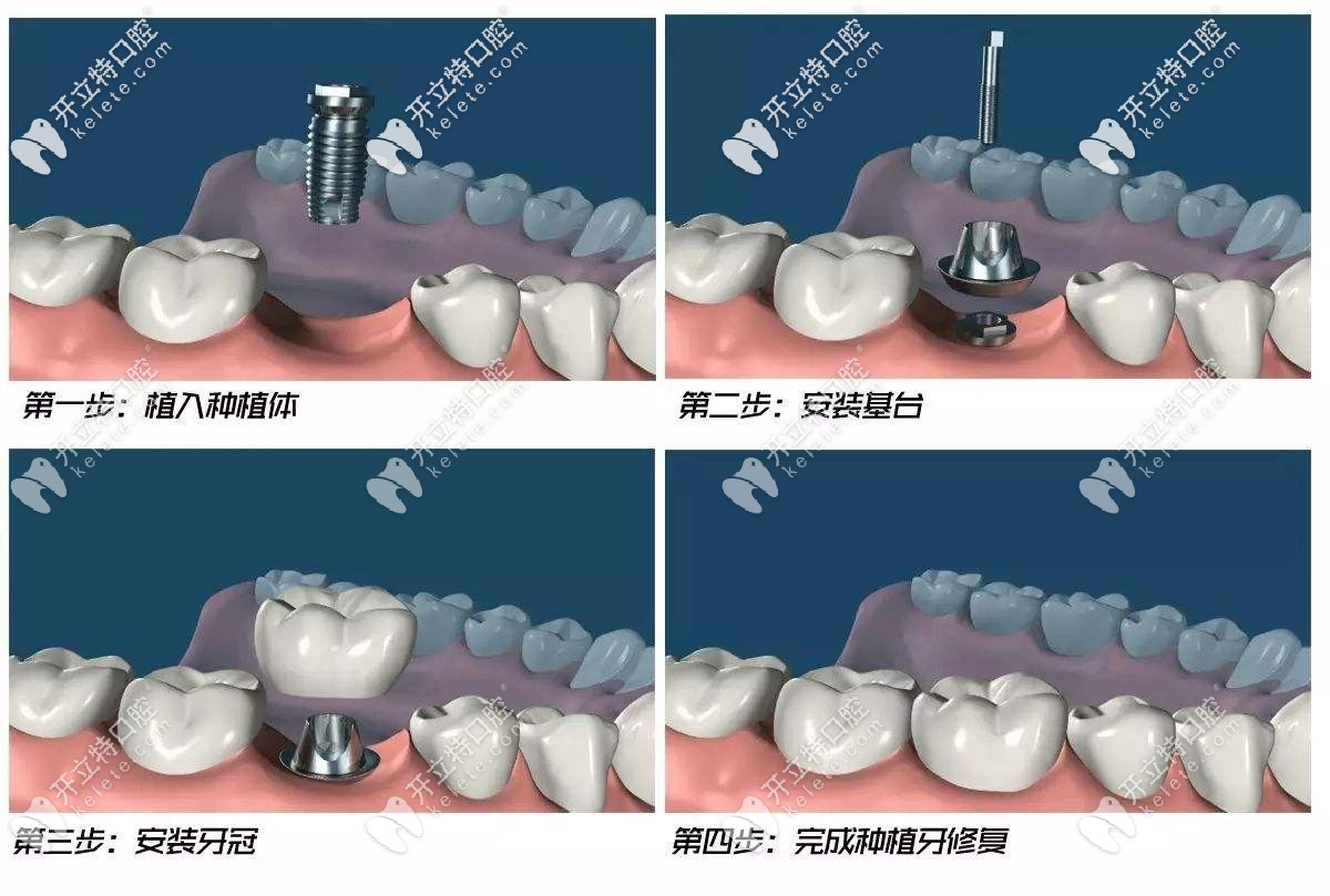 种植牙过程示意图