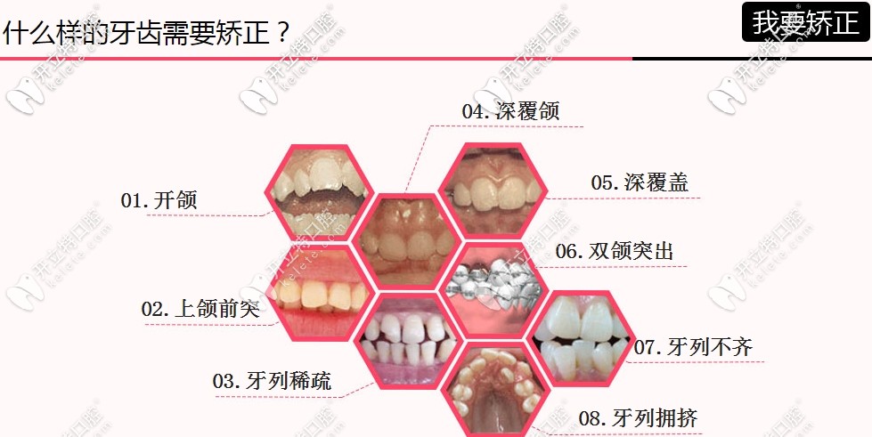 牙齿矫正适应症 牙齿矫正适应症