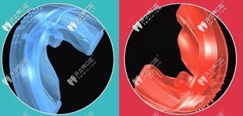 早期功能矫治器 早期功能矫治器