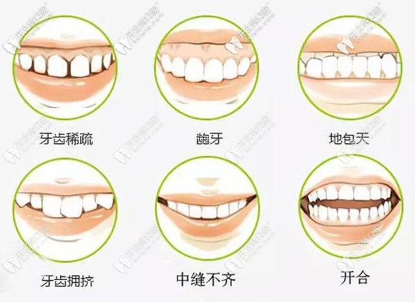 哪种类型牙齿需要做矫正