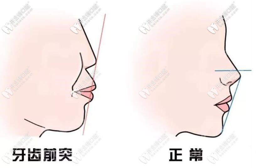 齿槽型嘴突