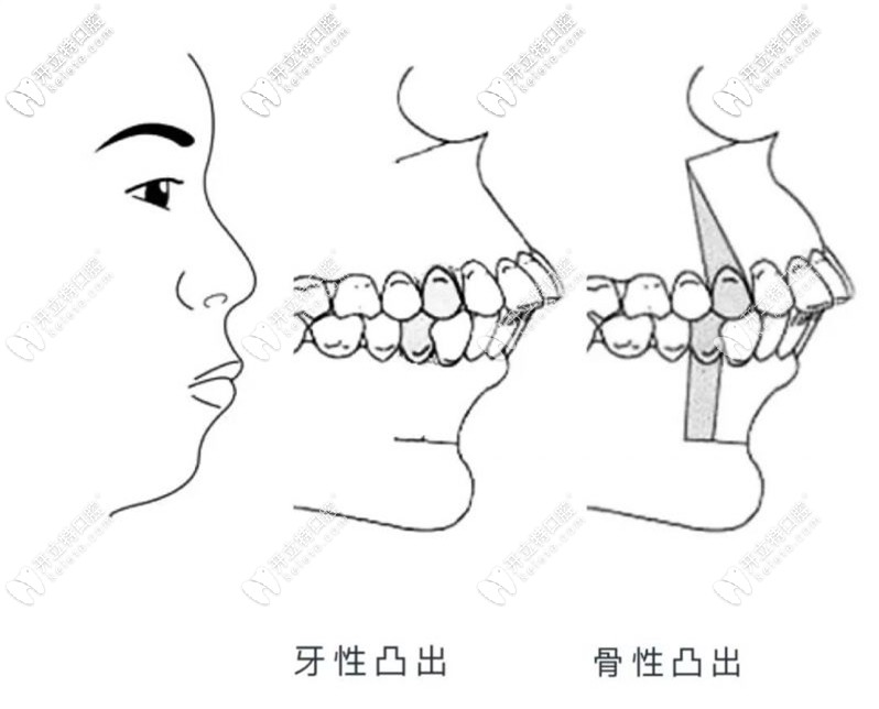 齿性凸嘴和骨性凸嘴