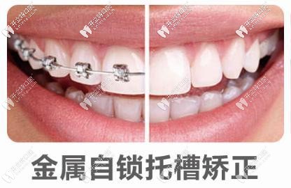 金属自锁托槽 金属自锁托槽