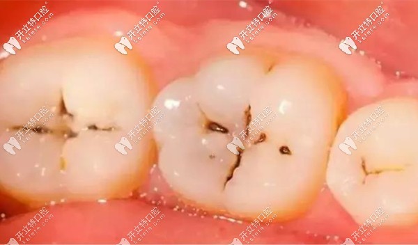 牙齿上有个小黑点是否需要治疗得看是什么原因引起的