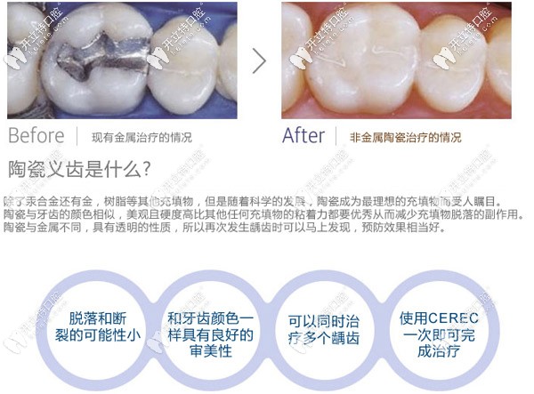 补牙采用非金属治疗