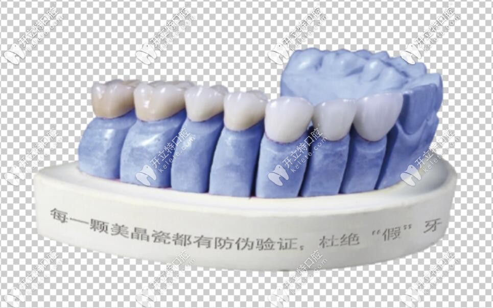 沪鸽美晶瓷全瓷牙模型 沪鸽美晶瓷全瓷牙模型