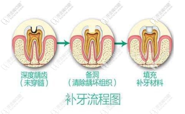 补牙流程 补牙流程